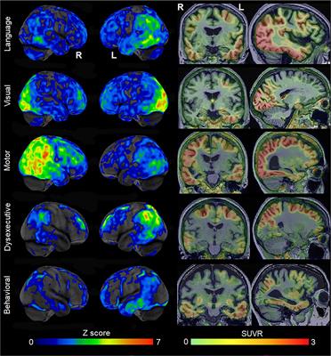 Atypical clinical variants of Alzheimer’s disease: are they really atypical?